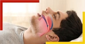 obstructive sleep apnea