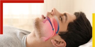 obstructive sleep apnea