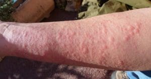 Skin Allergy