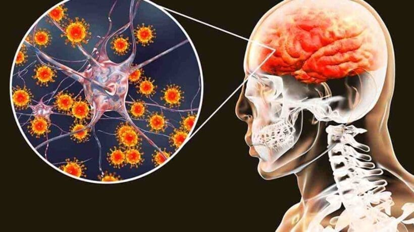 Viral Encephalitis 1 Viral Encephalitis: হুহু করে ছড়াচ্ছে ভাইরাল এনসেফালাইটিস! এক মাসে কাড়লো ৫৬ জনের প্রাণ!