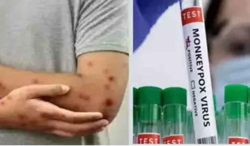 Mpox new variant first case found in kerala india