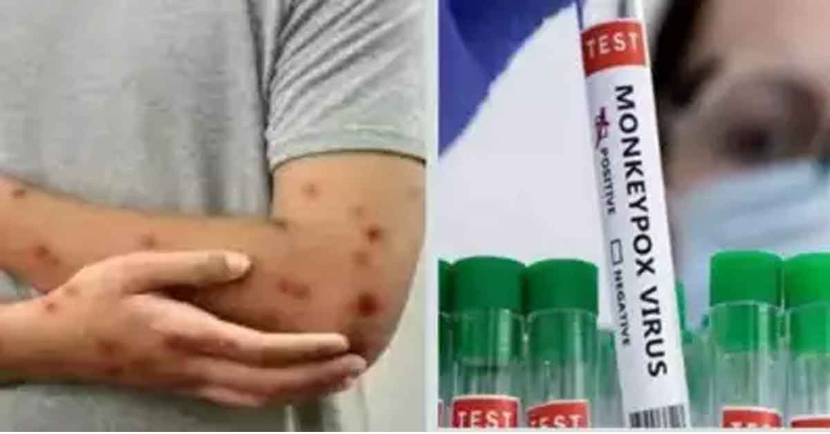 Mpox new variant first case found in kerala india