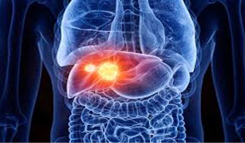 Fatty liver causes cancer