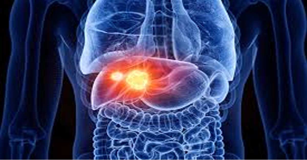 Fatty liver causes cancer