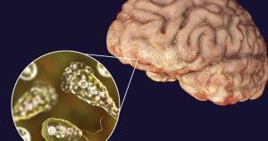 Brain Eating Amoeba